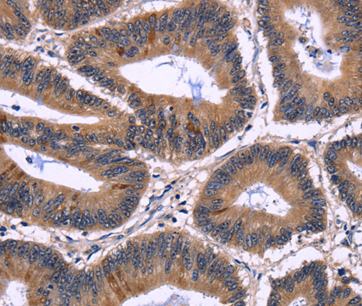 Immunohistochemistry of paraffin-embedded Human colon cancer tissue using NFATC3 Polyclonal Antibody at dilution 1:60