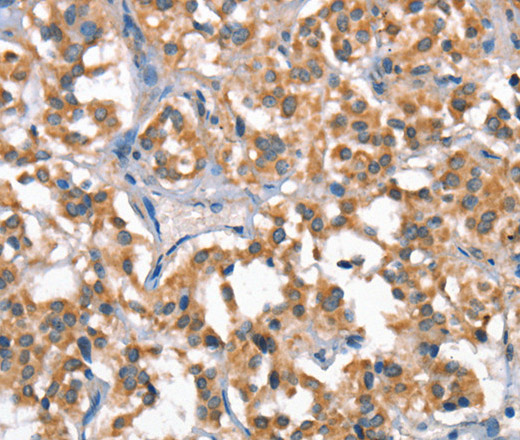 Immunohistochemistry of paraffin-embedded Human thyroid cancer tissue using HGF Polyclonal Antibody at dilution 1:65