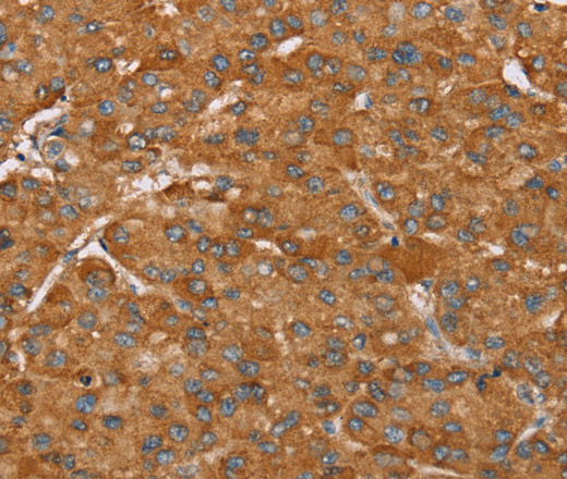 Immunohistochemistry of paraffin-embedded Human liver cancer tissue using PAGE5 Polyclonal Antibody at dilution 1:55