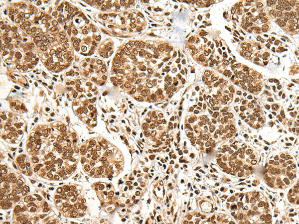 Immunohistochemistry of paraffin-embedded Human esophagus cancer tissue  using BRSK1 Polyclonal Antibody at dilution of 1:95(?200)