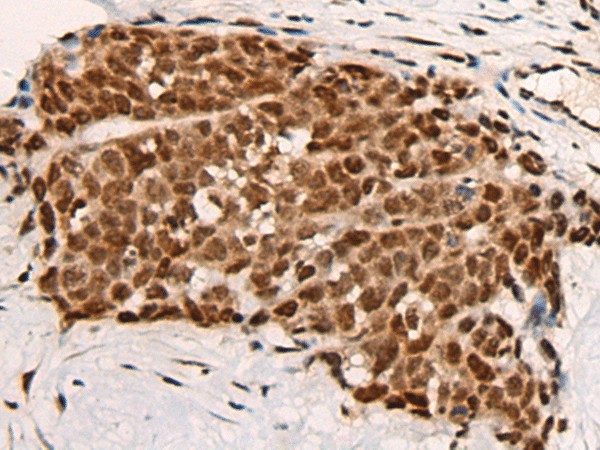 Immunohistochemistry of paraffin-embedded Human thyroid cancer tissue  using HGH1 Polyclonal Antibody at dilution of 1:45(?200)