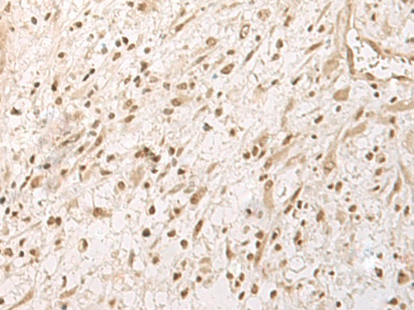 Immunohistochemistry of paraffin-embedded Human ovarian cancer tissue  using RRP1 Polyclonal Antibody at dilution of 1:45(?200)