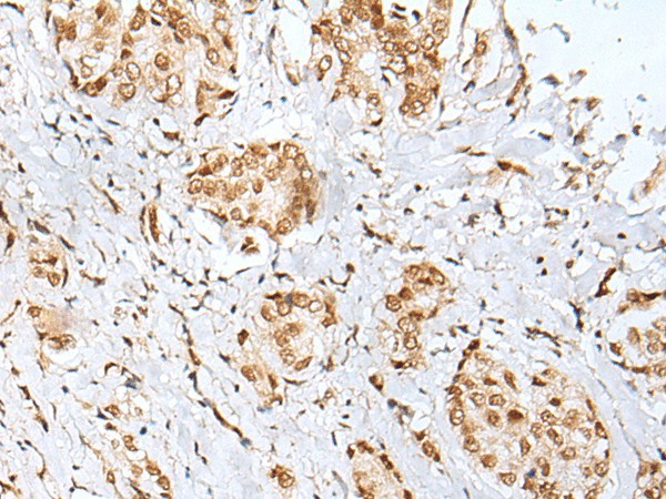 Immunohistochemistry of paraffin-embedded Human breast cancer tissue  using ZNF354A Polyclonal Antibody at dilution of 1:40(?200)