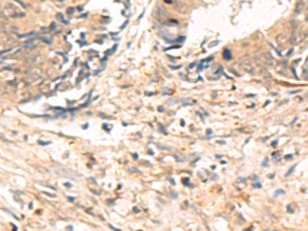 Immunohistochemistry of paraffin-embedded Human colorectal cancer tissue  using ABHD2 Polyclonal Antibody at dilution of 1:40(?200)