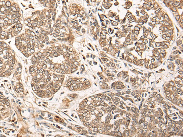 Immunohistochemistry of paraffin-embedded Human esophagus cancer tissue  using CA5B Polyclonal Antibody at dilution of 1:85(?200)