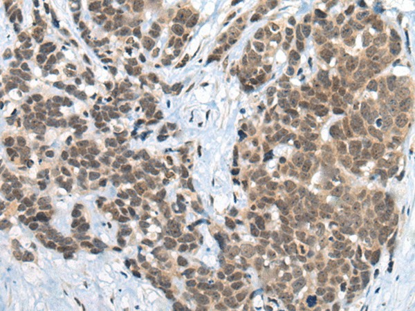 Immunohistochemistry of paraffin-embedded Human thyroid cancer tissue  using ZNF83 Polyclonal Antibody at dilution of 1:50(?200)