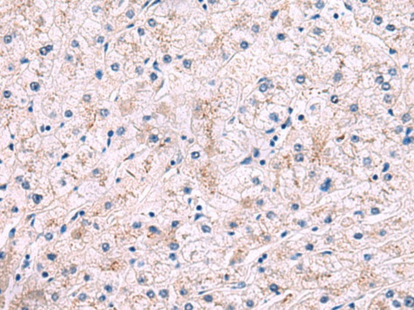 Immunohistochemistry of paraffin-embedded Human liver cancer tissue  using IP6K2 Polyclonal Antibody at dilution of 1:50(?200)