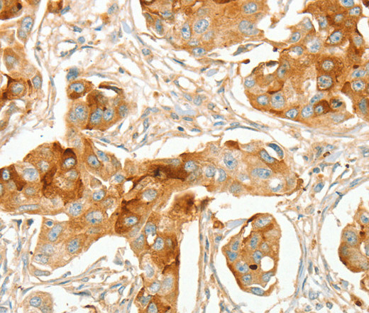 Immunohistochemistry of paraffin-embedded Human breast cancer using ACE1 Polyclonal Antibody at dilution of 1:70