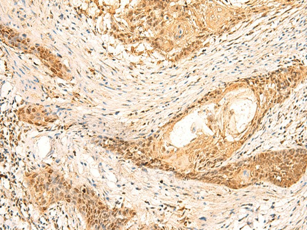 Immunohistochemistry of paraffin-embedded Human esophagus cancer tissue  using EEF1AKMT2 Polyclonal Antibody at dilution of 1:50(?200)