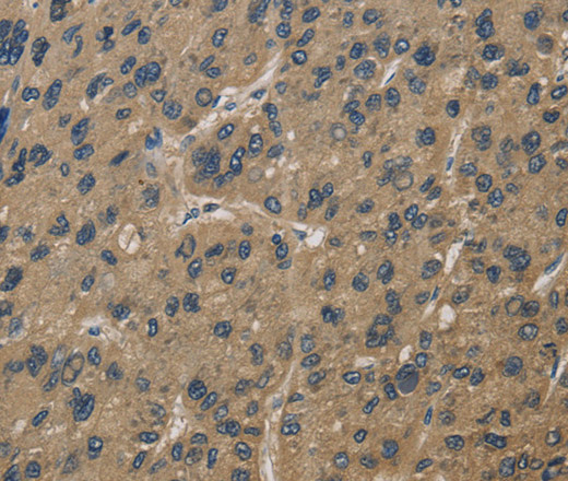 Immunohistochemistry of paraffin-embedded Human liver cancer using CORO1C Polyclonal Antibody at dilution of 1:60