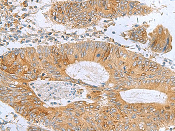 Immunohistochemistry of paraffin-embedded Human colorectal cancer tissue  using TXNDC12 Polyclonal Antibody at dilution of 1:60(?200)