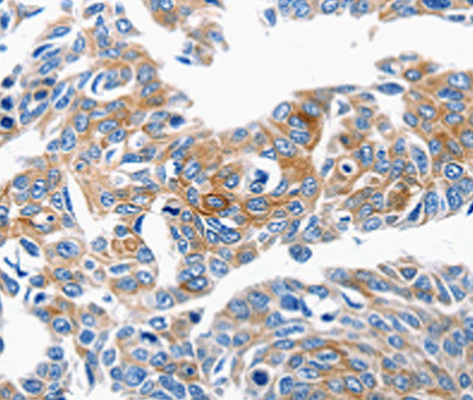 Immunohistochemistry of paraffin-embedded Human lung cancer tissue using CCL6 Polyclonal Antibody at dilution 1:50