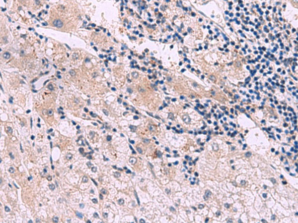 Immunohistochemistry of paraffin-embedded Human liver cancer tissue  using NMRK2 Polyclonal Antibody at dilution of 1:55(?200)