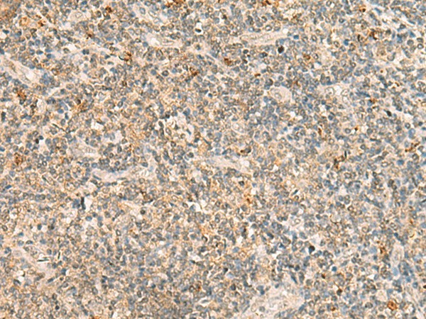 Immunohistochemistry of paraffin-embedded Human tonsil tissue  using TBCK Polyclonal Antibody at dilution of 1:25(?200)