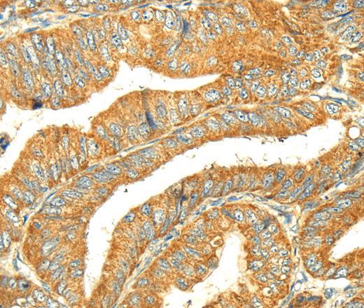 Immunohistochemistry of paraffin-embedded Human colon cancer tissue using GK1 Polyclonal Antibody at dilution 1:60