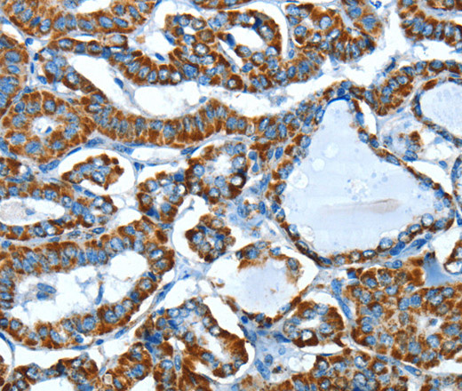 Immunohistochemistry of paraffin-embedded Human thyroid cancer using ALDH6A1 Polyclonal Antibody at dilution of 1:45