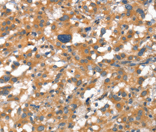 Immunohistochemistry of paraffin-embedded Human thyroid cancer tissue using VE-Cadherin Polyclonal Antibody at dilution 1:50