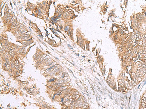 Immunohistochemistry of paraffin-embedded Human colorectal cancer tissue  using HLA-E Polyclonal Antibody at dilution of 1:50(?200)