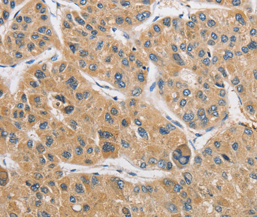 Immunohistochemistry of paraffin-embedded Human liver cancer using ARHGAP15 Polyclonal Antibody at dilution of 1:50