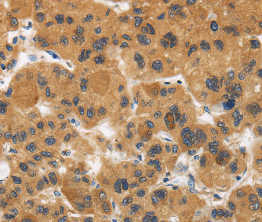 Immunohistochemistry of paraffin-embedded Human liver cancer tissue using CALU Polyclonal Antibody at dilution 1:40