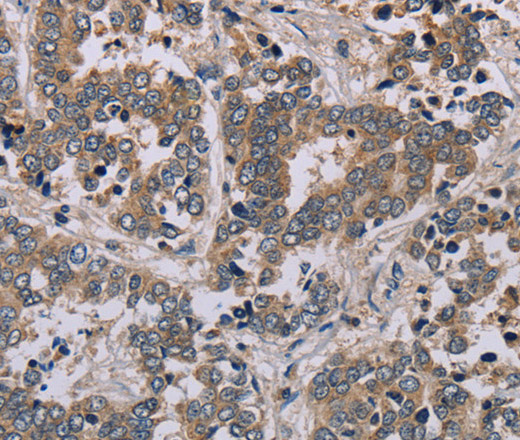 Immunohistochemistry of paraffin-embedded Human liver cancer tissue using AATK Polyclonal Antibody at dilution 1:45