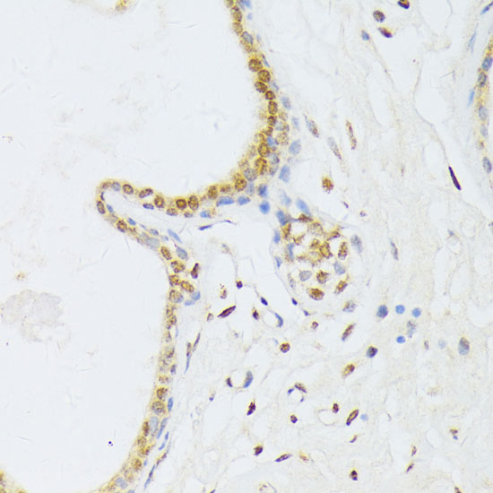 Immunohistochemistry of paraffin-embedded Human breast cancer using ANKRD52 Polyclonal Antibody at dilution of 1:100 (40x lens).