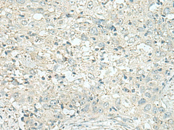 Immunohistochemistry of paraffin-embedded Human esophagus cancer tissue  using DENND6A Polyclonal Antibody at dilution of 1:120(?200)