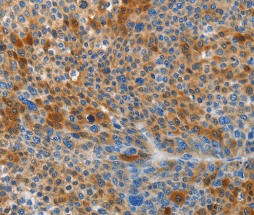 Immunohistochemistry of paraffin-embedded Human liver cancer tissue using HTRA3 Polyclonal Antibody at dilution 1:45