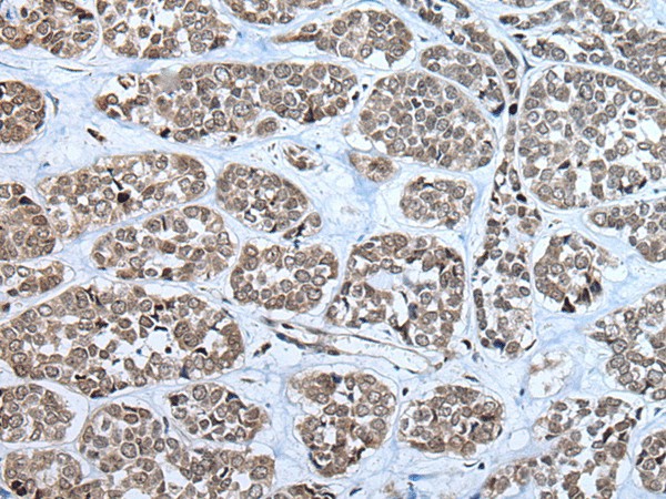 Immunohistochemistry of paraffin-embedded Human esophagus cancer tissue  using RPF2 Polyclonal Antibody at dilution of 1:40(?200)