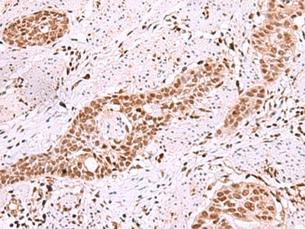 Immunohistochemistry of paraffin-embedded Human esophagus cancer tissue  using ISL2 Polyclonal Antibody at dilution of 1:40(?200)