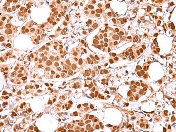 Immunohistochemistry of paraffin-embedded Human breast cancer tissue  using RCOR3 Polyclonal Antibody at dilution of 1:60(?200)