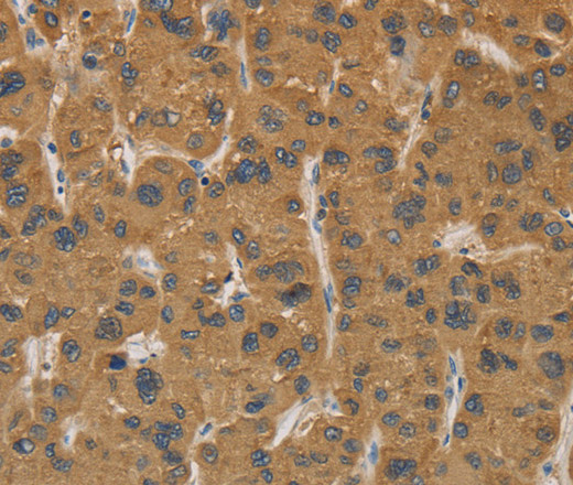 Immunohistochemistry of paraffin-embedded Human liver cancer tissue using CYP17A1 Polyclonal Antibody at dilution 1:30