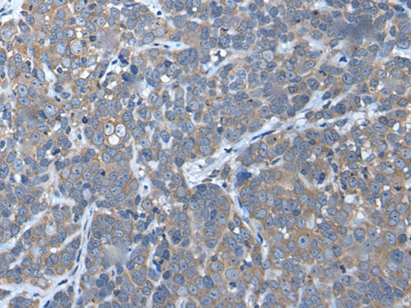 Immunohistochemistry of paraffin-embedded Human thyroid cancer tissue  using UBAC2 Polyclonal Antibody at dilution of 1:50(?200)