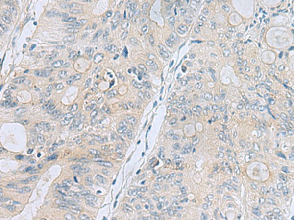 Immunohistochemistry of paraffin-embedded Human colorectal cancer tissue  using APOBR Polyclonal Antibody at dilution of 1:35(?200)