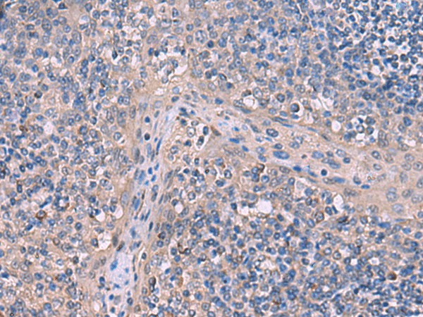 Immunohistochemistry of paraffin-embedded Human tonsil tissue  using ITPR2 Polyclonal Antibody at dilution of 1:65(?200)