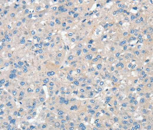 Immunohistochemistry of paraffin-embedded Human liver cancer using SNX3 Polyclonal Antibody at dilution of 1:30