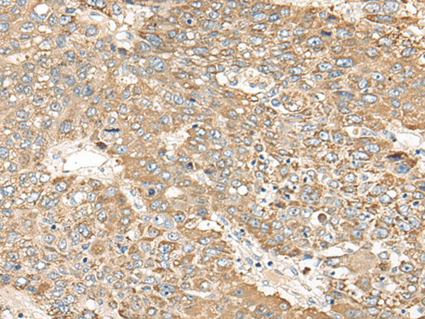 Immunohistochemistry of paraffin-embedded Human liver cancer tissue  using C1orf101 Polyclonal Antibody at dilution of 1:65(?200)