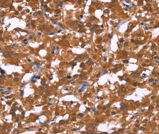 Immunohistochemistry of paraffin-embedded Human thyroid cancer tissue using HLTF Polyclonal Antibody at dilution 1:30