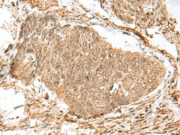 Immunohistochemistry of paraffin-embedded Human esophagus cancer tissue  using GEMIN4 Polyclonal Antibody at dilution of 1:30(?200)