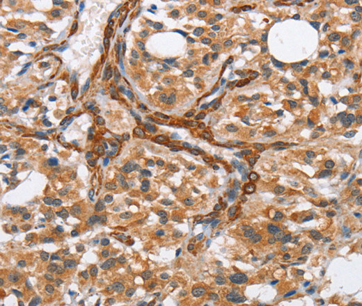 Immunohistochemistry of paraffin-embedded Human thyroid cancer tissue using BUB1 Polyclonal Antibody at dilution 1:50