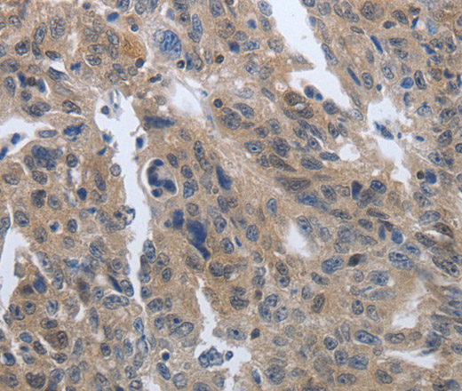 Immunohistochemistry of paraffin-embedded Human ovarian cancer tissue using PDGFB Polyclonal Antibody at dilution 1:40