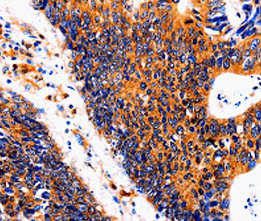 Immunohistochemistry of paraffin-embedded Human colon cancer tissue using IL18BP Polyclonal Antibody at dilution 1:50