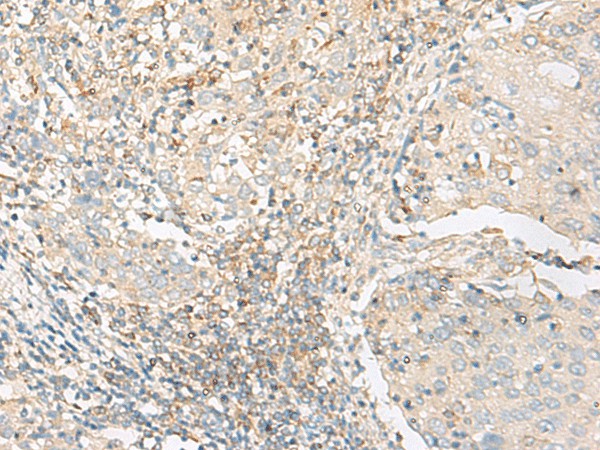 Immunohistochemistry of paraffin-embedded Human cervical cancer tissue  using GLIS1 Polyclonal Antibody at dilution of 1:50(?200)