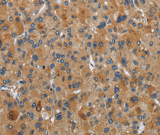 Immunohistochemistry of paraffin-embedded Human liver cancer tissue using FLCN Polyclonal Antibody at dilution 1:40