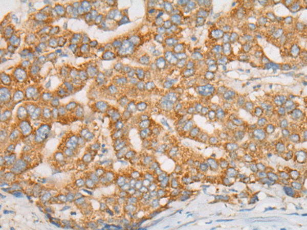 Immunohistochemistry of paraffin-embedded Human liver cancer tissue  using ATXN7 Polyclonal Antibody at dilution of 1:60(?200)