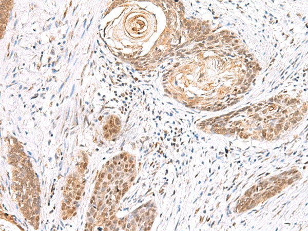 Immunohistochemistry of paraffin-embedded Human esophagus cancer tissue  using EWSR1 Polyclonal Antibody at dilution of 1:70(?200)