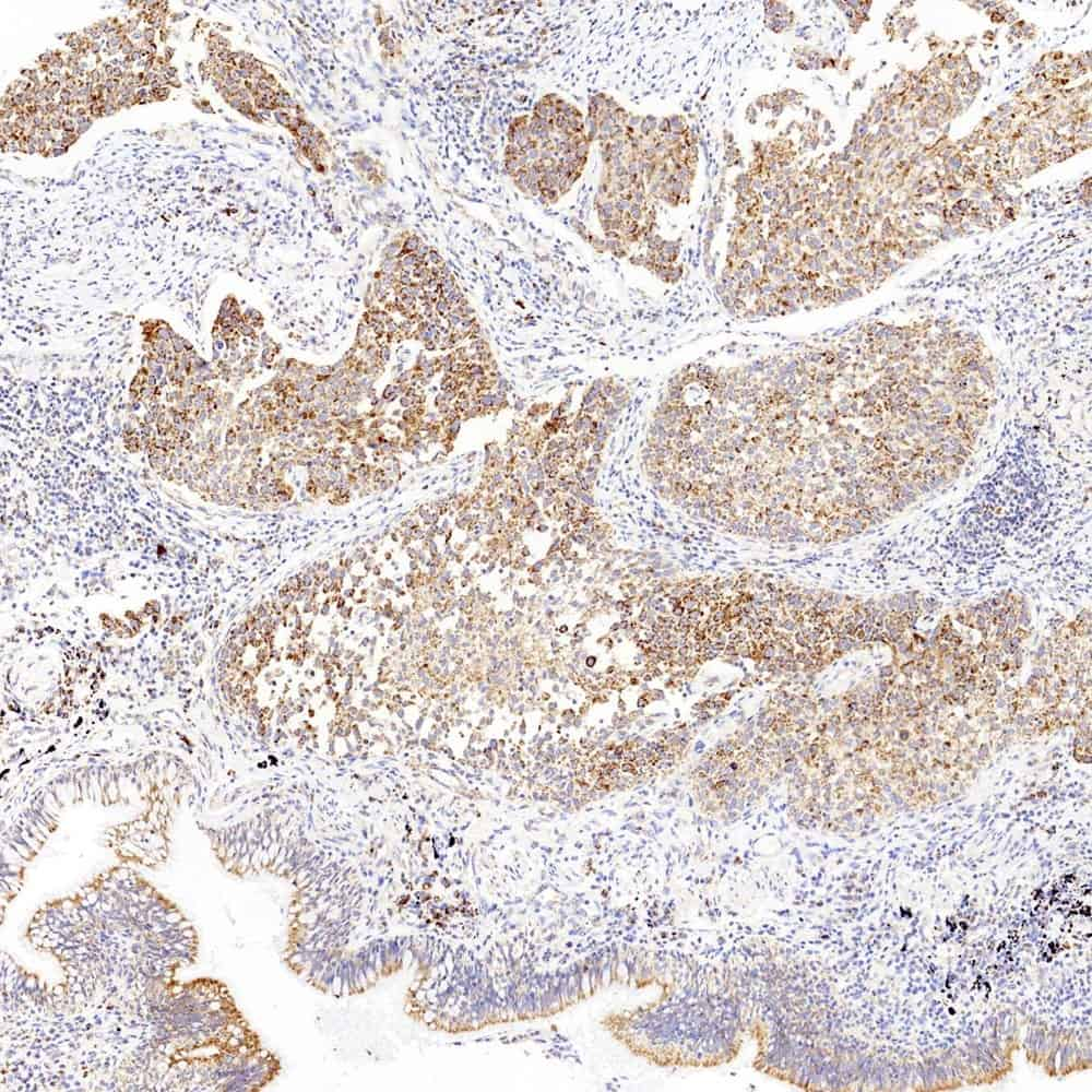 Immunohistochemistry analysis of paraffin-embedded human lung cancer  using CYCS Polyclonal Antibody at dilution of 1:1000.