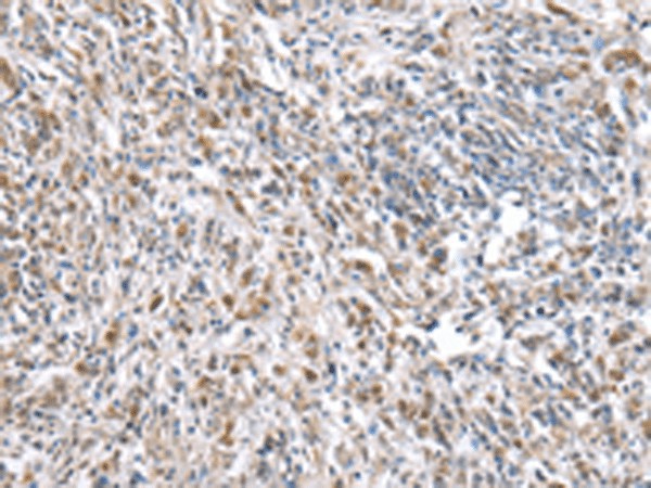 Immunohistochemistry of paraffin-embedded Human prost ate cancer tissue  using RNF115 Polyclonal Antibody at dilution of 1:45(?200)