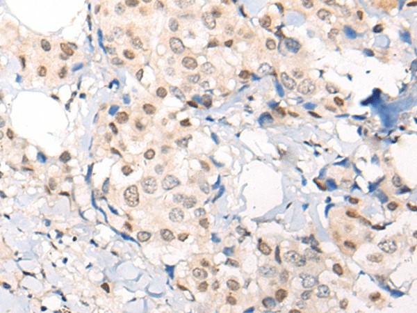 Immunohistochemistry of paraffin-embedded Human breast cancer tissue  using VPS51 Polyclonal Antibody at dilution of 1:65(?200)