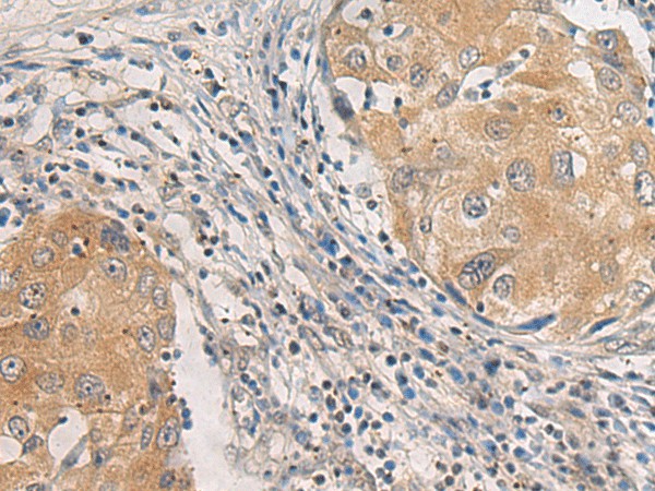 Immunohistochemistry of paraffin-embedded Human breast cancer tissue  using AGAP3 Polyclonal Antibody at dilution of 1:25(?200)